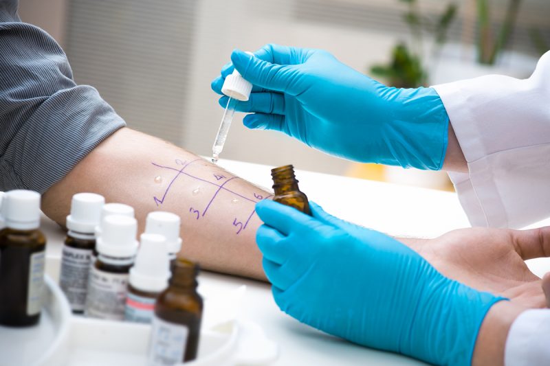 Allergy skin prick test being administered on a patient's forearm